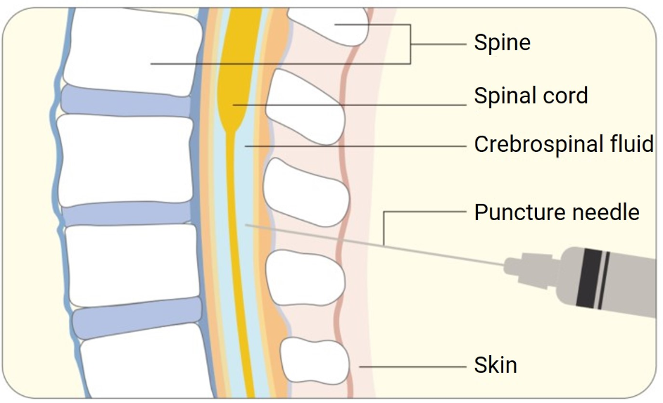 Intrathecal Route: Mechanism, Uses, and Challenges